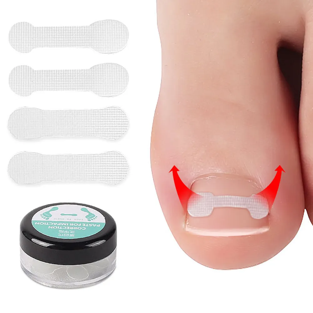 (杰恆)los1172正甲貼甲溝嵌甲矯正器腳趾甲貼片拉拉用指甲刀鉗趾甲修腳套 歷史價格詳細信息