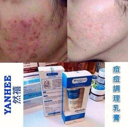 粉刺暗瘡專業青春棒4支入[65480]不鏽鋼雙頭擠痘棒 黑頭粉刺 美容針 清潔粉刺 歷史價格詳細信息